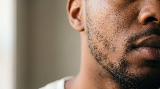 Close-up of a Black man's cheek and jawline showing subtle post-blemish dark marks